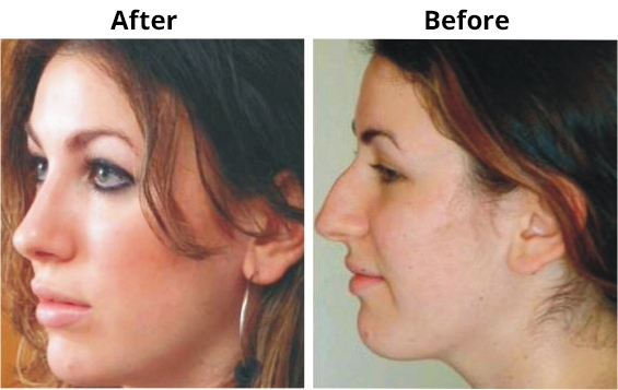 Rhinoplasty