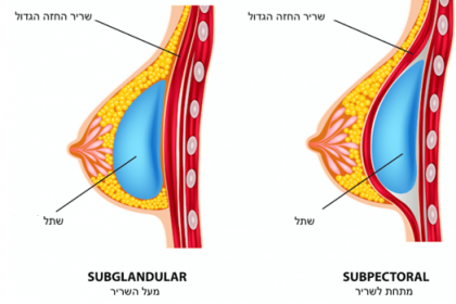 מעל או מתחת לשריר מהי השיטה הטובה ביותר להגדלת חזה